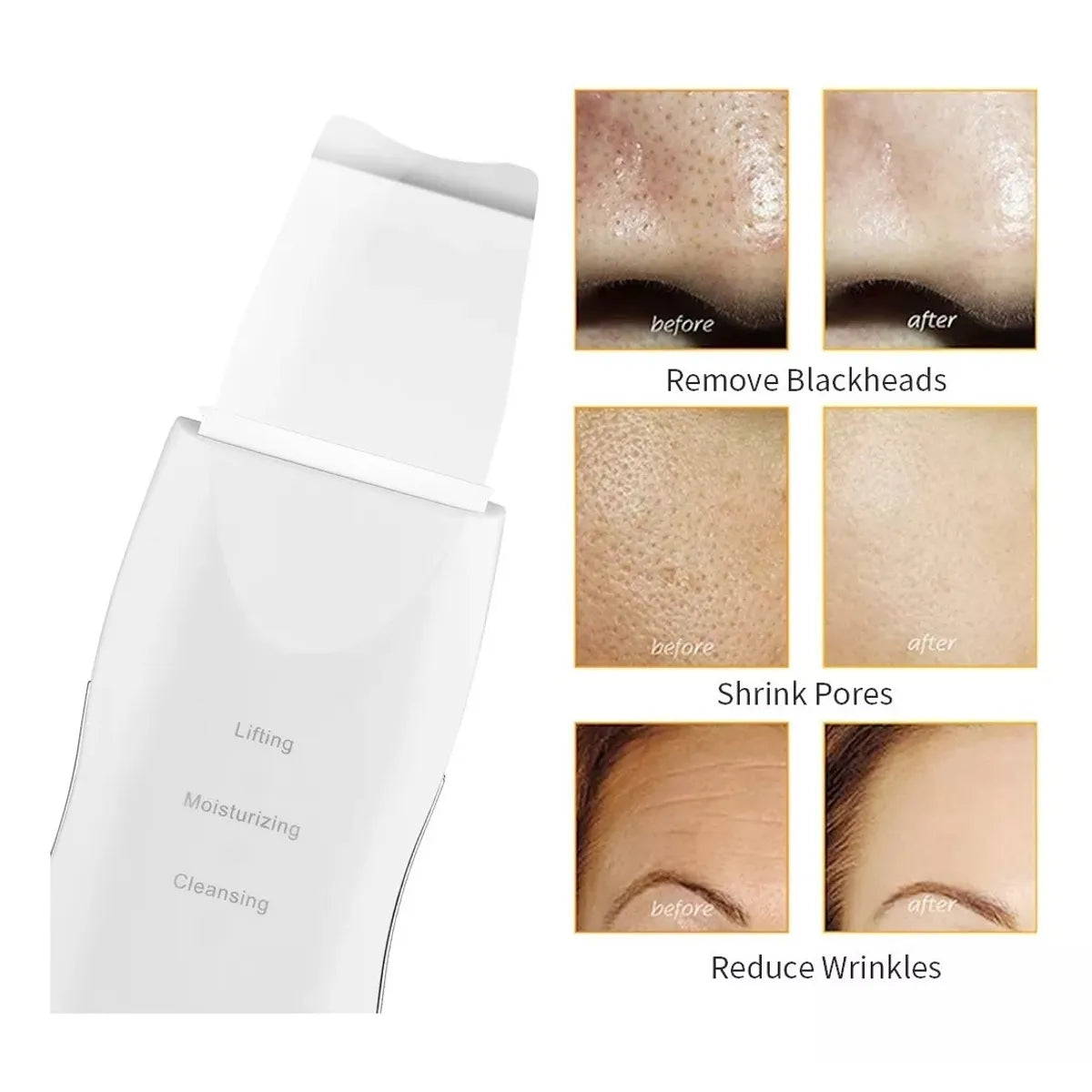 Espatula Peeling Ultrasonico Limpiador Facial Lifting